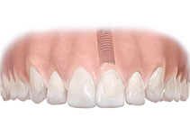 Single tooth implant and crown restoration
