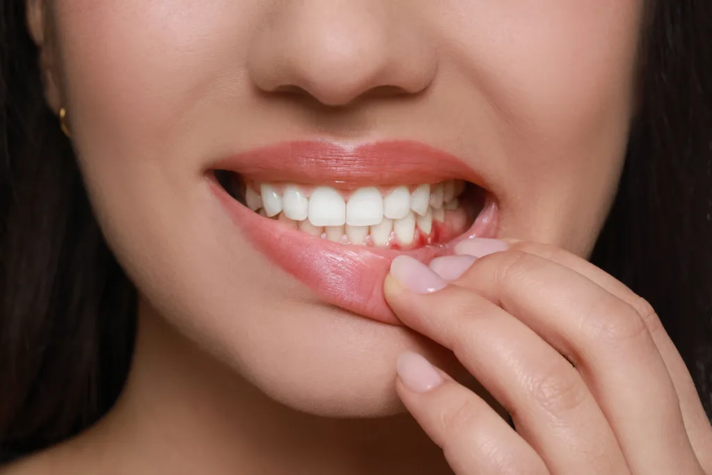 Smiling woman showing gum recession and the need for receding gum treatment