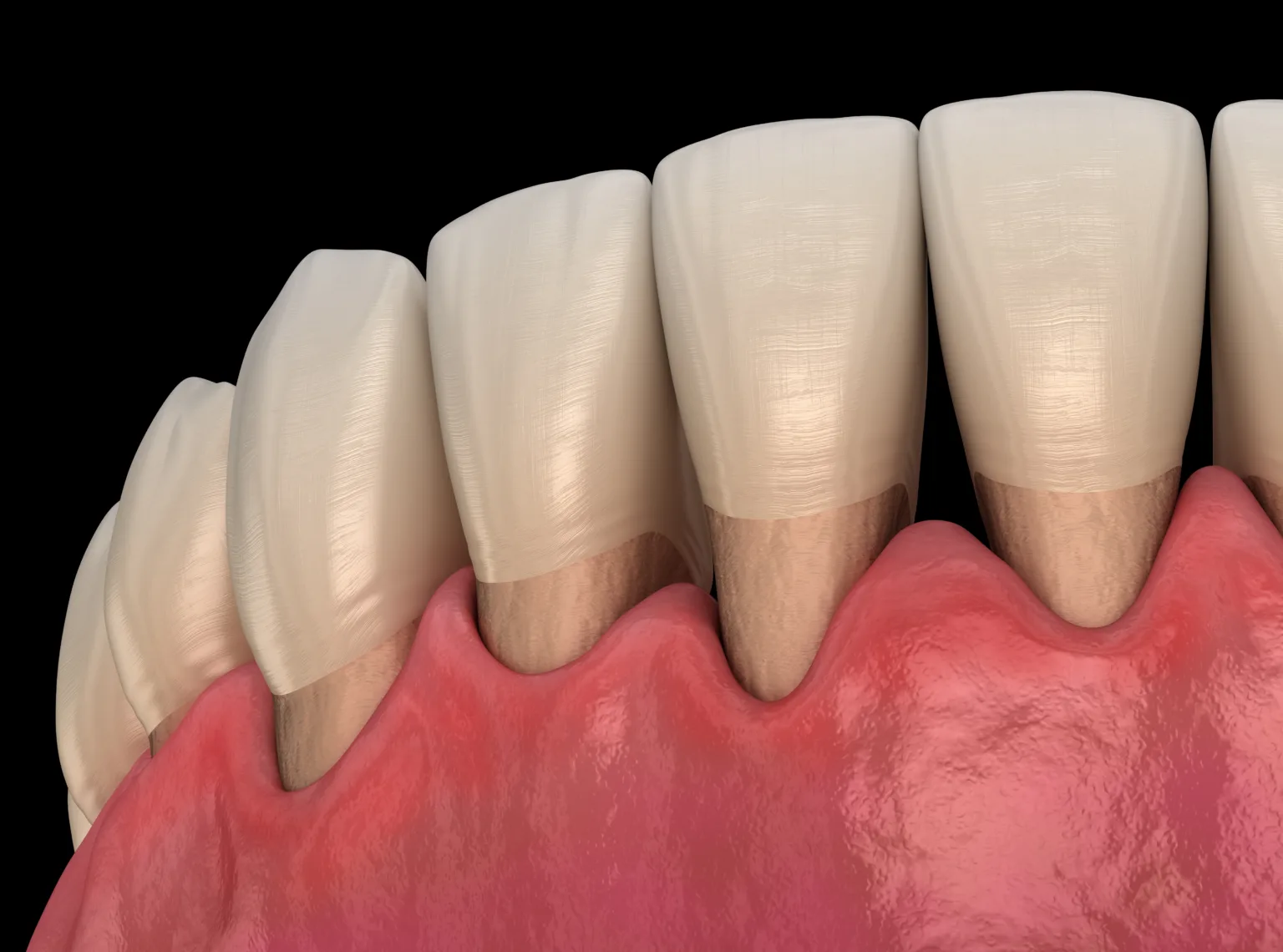 Visual representation of gum recession and receding gum treatment options